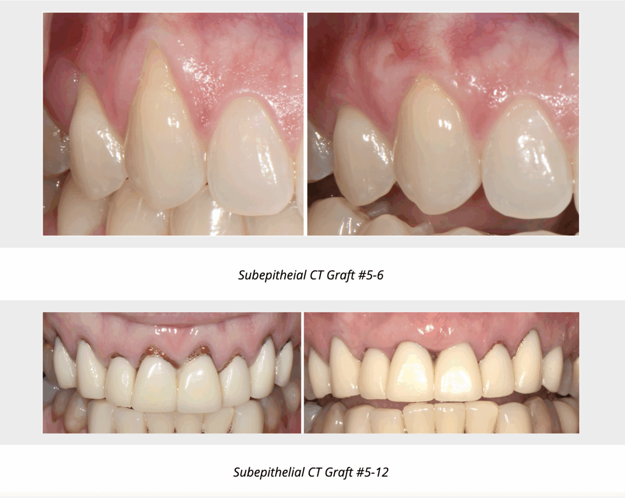 Connective Tissue Grafts: The Root Coverage Powerhouse | Tyler Periodontics